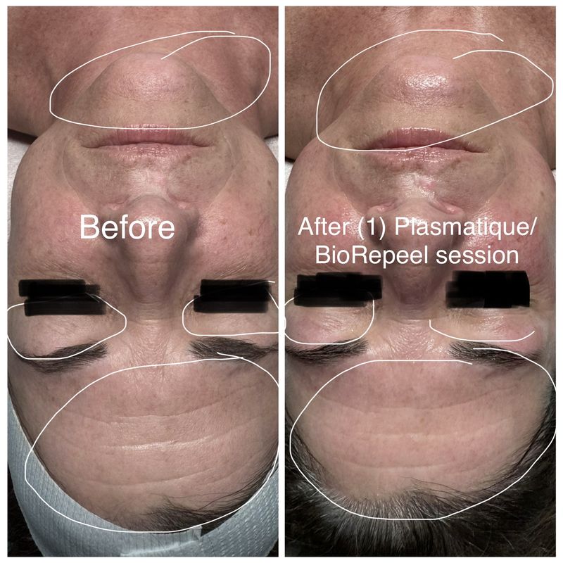 Before and after: forehead, eyes and lips. After one Plasmatique and BioRePeel session.