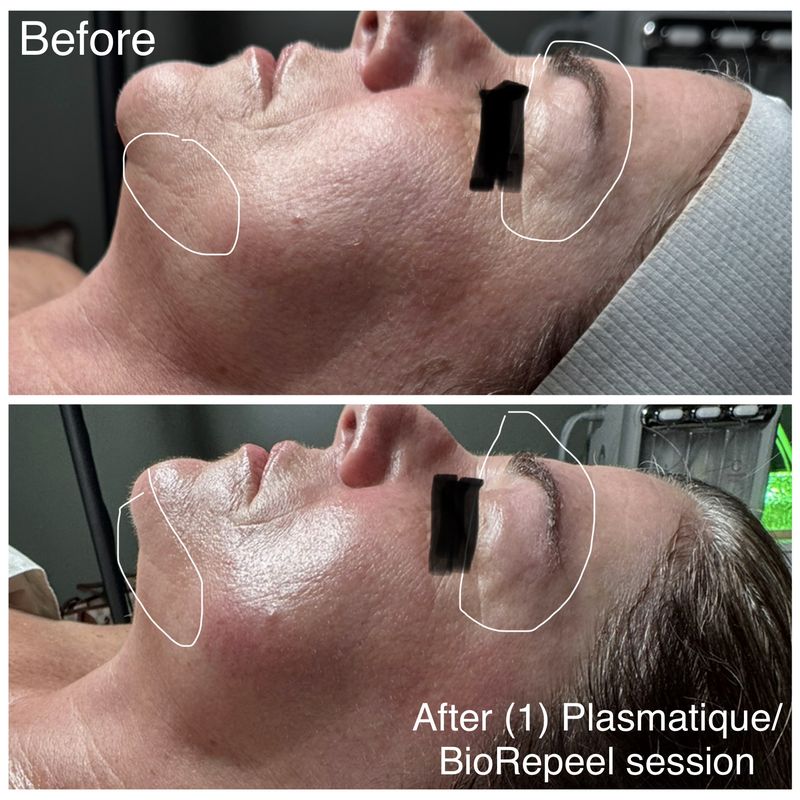 Before and after: cheek and jawline. After one Plasmatique and BioRePeel session.