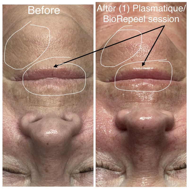 Before and after: upper lip and chin. After one Plasmatique and BioRePeel session.