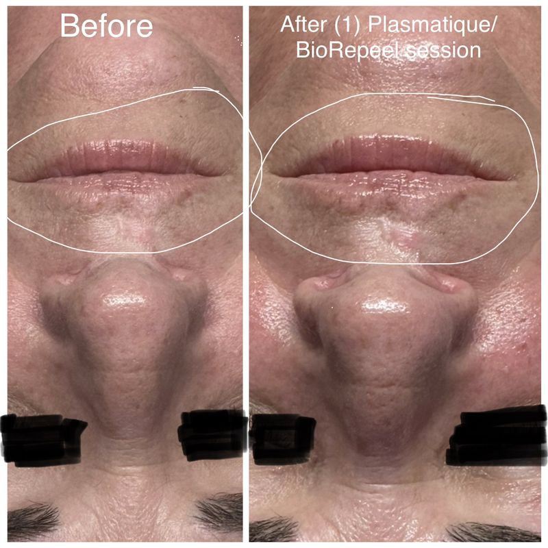 Before and after: lip lines. After one Plasmatique and BioRePeel session.